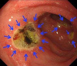 十二指腸潰瘍①
