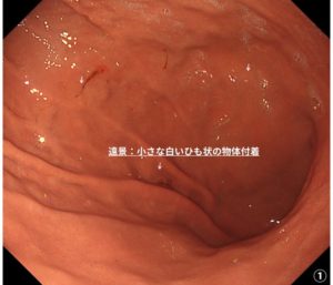 胃アニサキス症