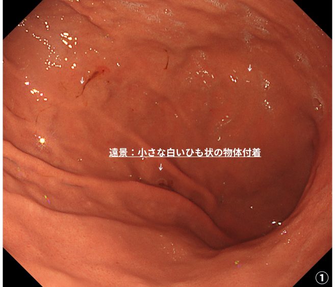 胃アニサキス症