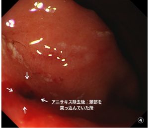 胃アニサキス症（アニサキス除去痕：虫頭刺入痕）